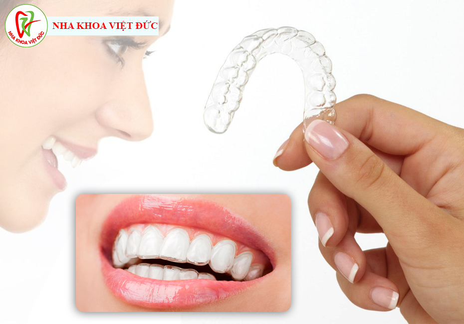 Niềng răng trong suốt Invisalign, không mắc cài