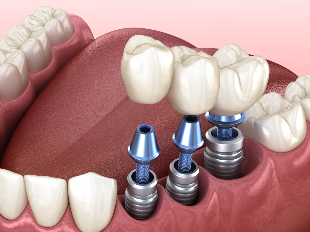 Những Điều Cần Biết Khi Cấy Ghép Implant