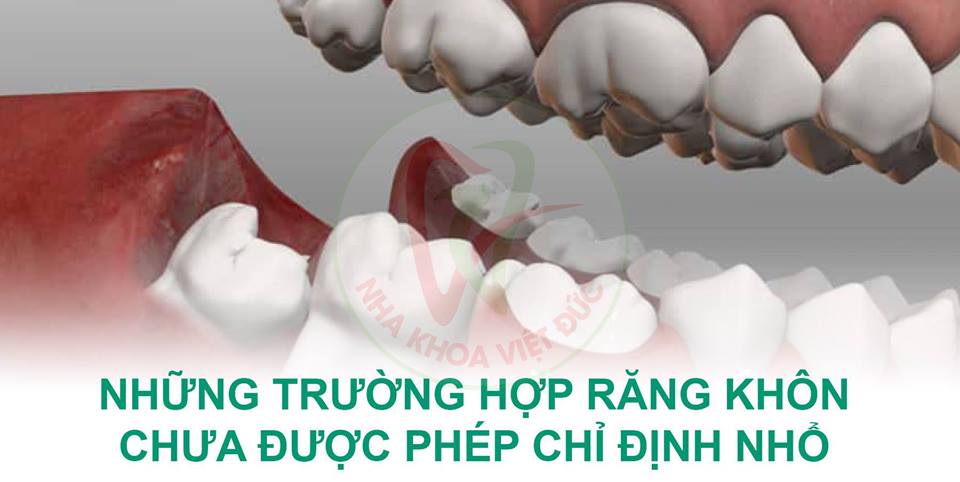 Những Trường Hợp Răng Khôn Chưa Được Phép Chỉ Định Nhổ