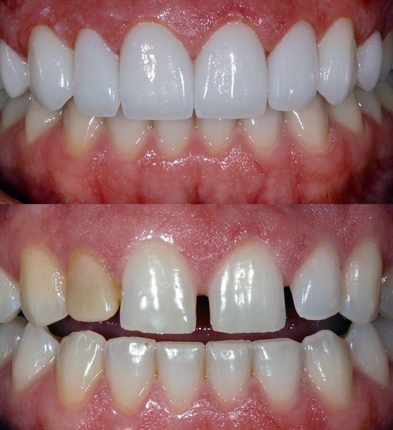 Mặt Dán Sứ Veneer