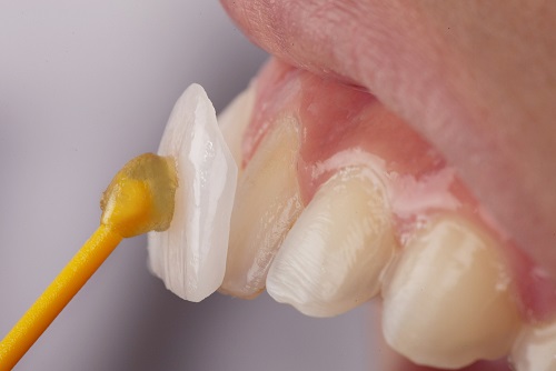 Ưu điểm mặt dán sứ veneer – Bảo tồn răng thật tối đa