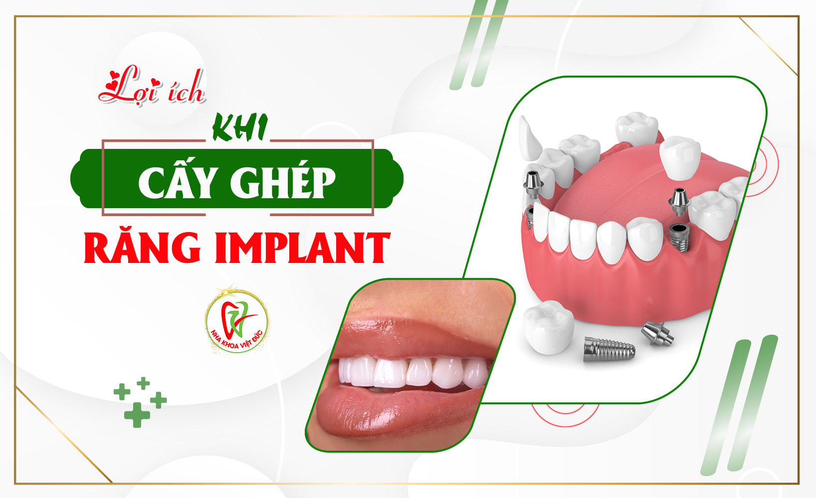 LỢI ÍCH KHI CẤY GHÉP RĂNG IMPLANT