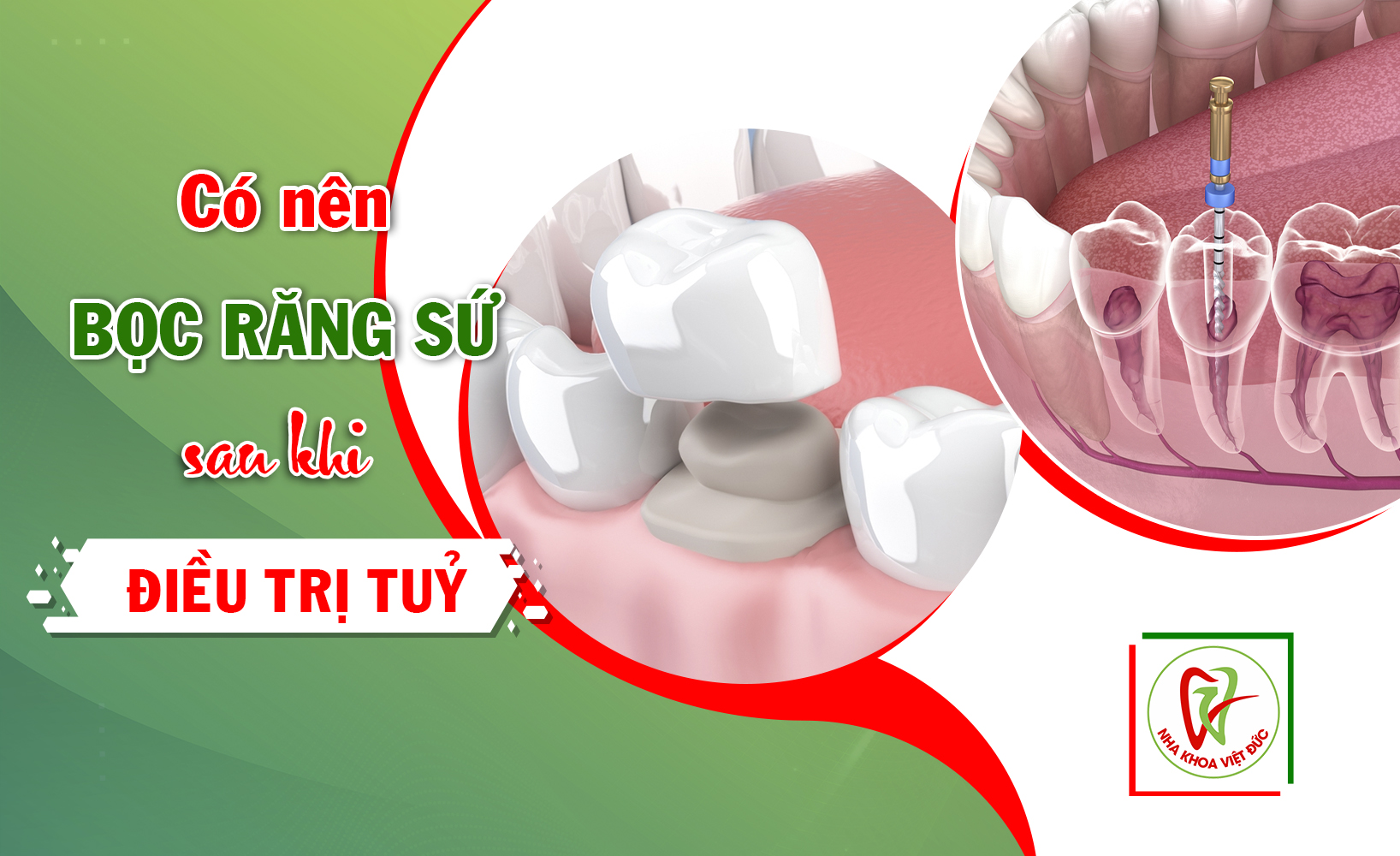 CÓ NÊN BỌC RĂNG SỨ SAU KHI ĐIỀU TRỊ TUỶ