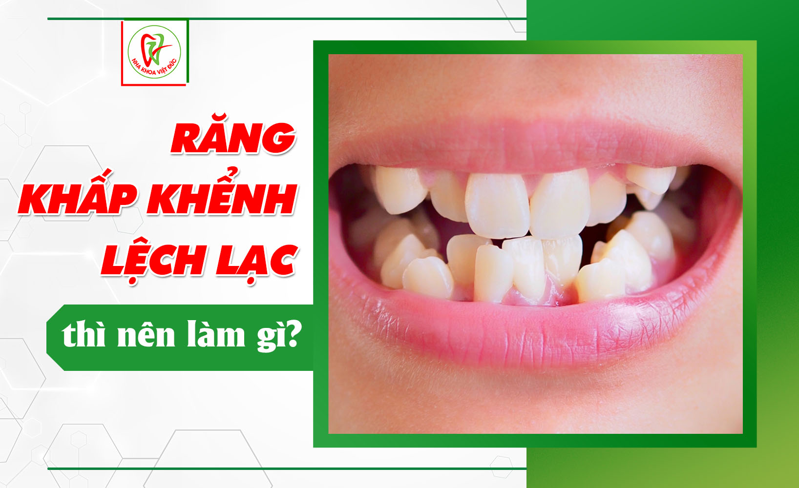 RĂNG KHẤP KHỂNH, LỆCH LẠC THÌ NÊN LÀM GÌ?