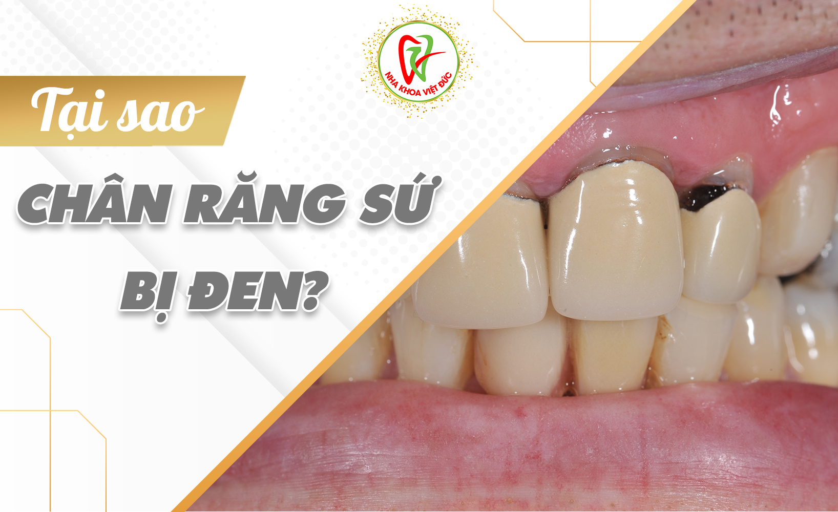 TẠI SAO CHÂN RĂNG SỨ BỊ ĐEN?