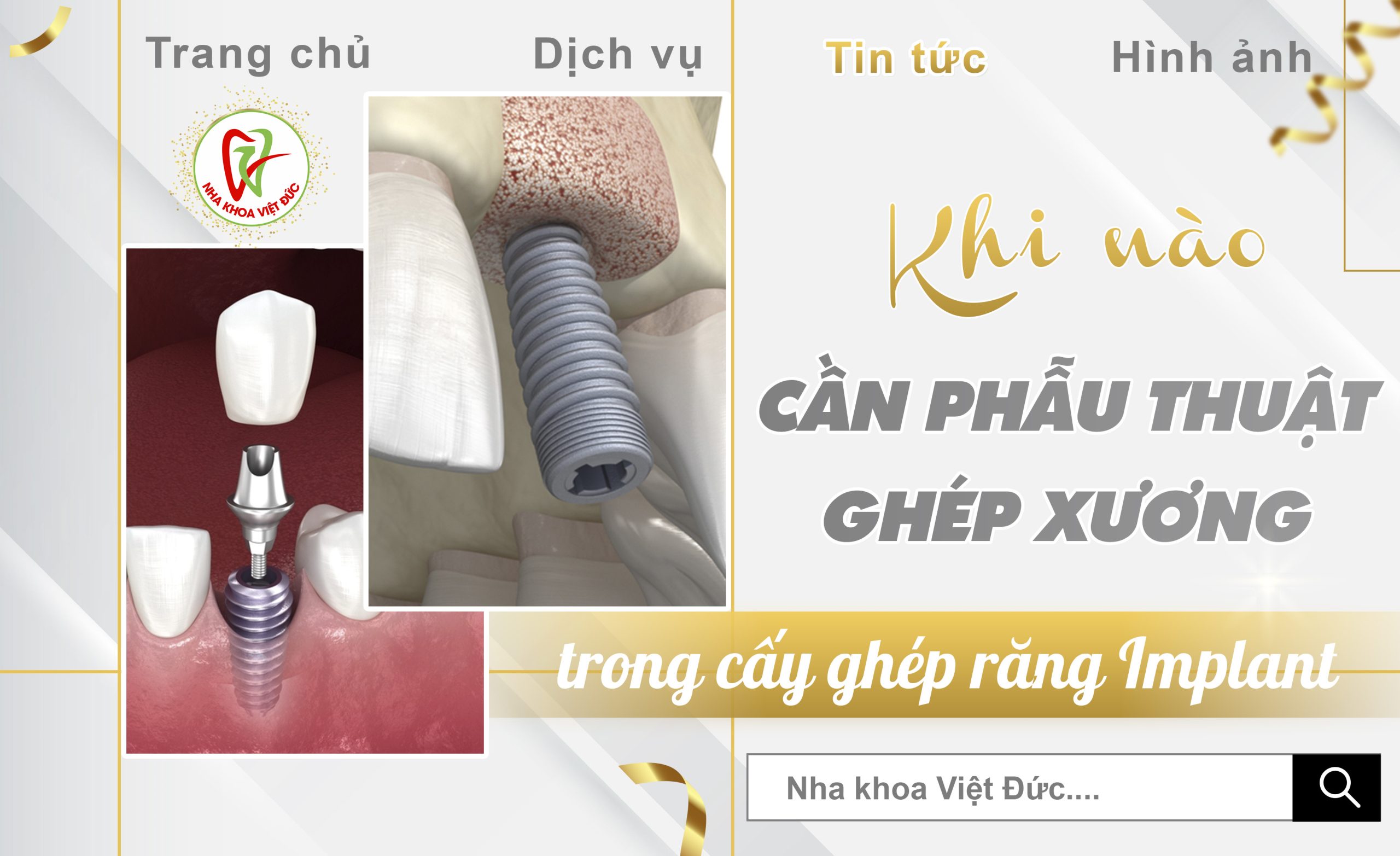 KHI NÀO CẦN PHẪU THUẬT GHÉP XƯƠNG TRONG CẤY GHÉP RĂNG IMPLANT?