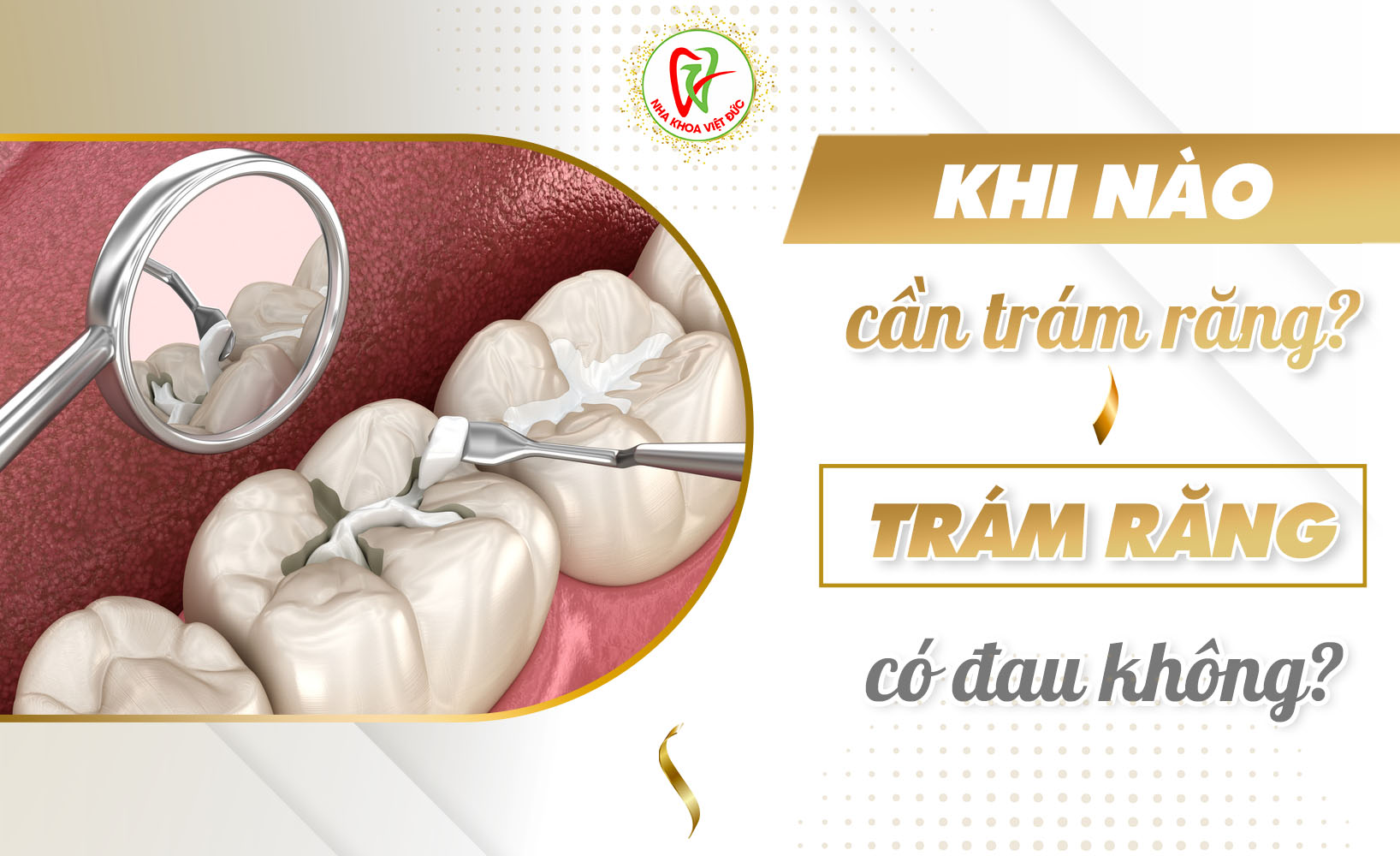 KHI NÀO CẦN TRÁM RĂNG? TRÁM RĂNG CÓ ĐAU KHÔNG?