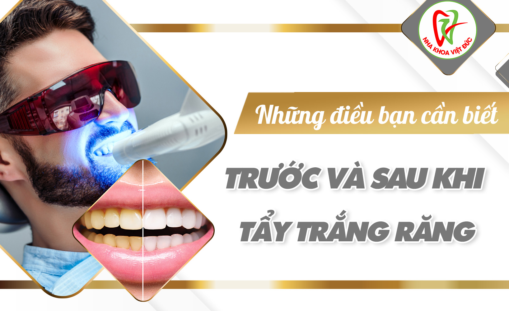 NHỮNG ĐIỀU BẠN CẦN BIẾT TRƯỚC VÀ SAU KHI TẨY TRẮNG RĂNG