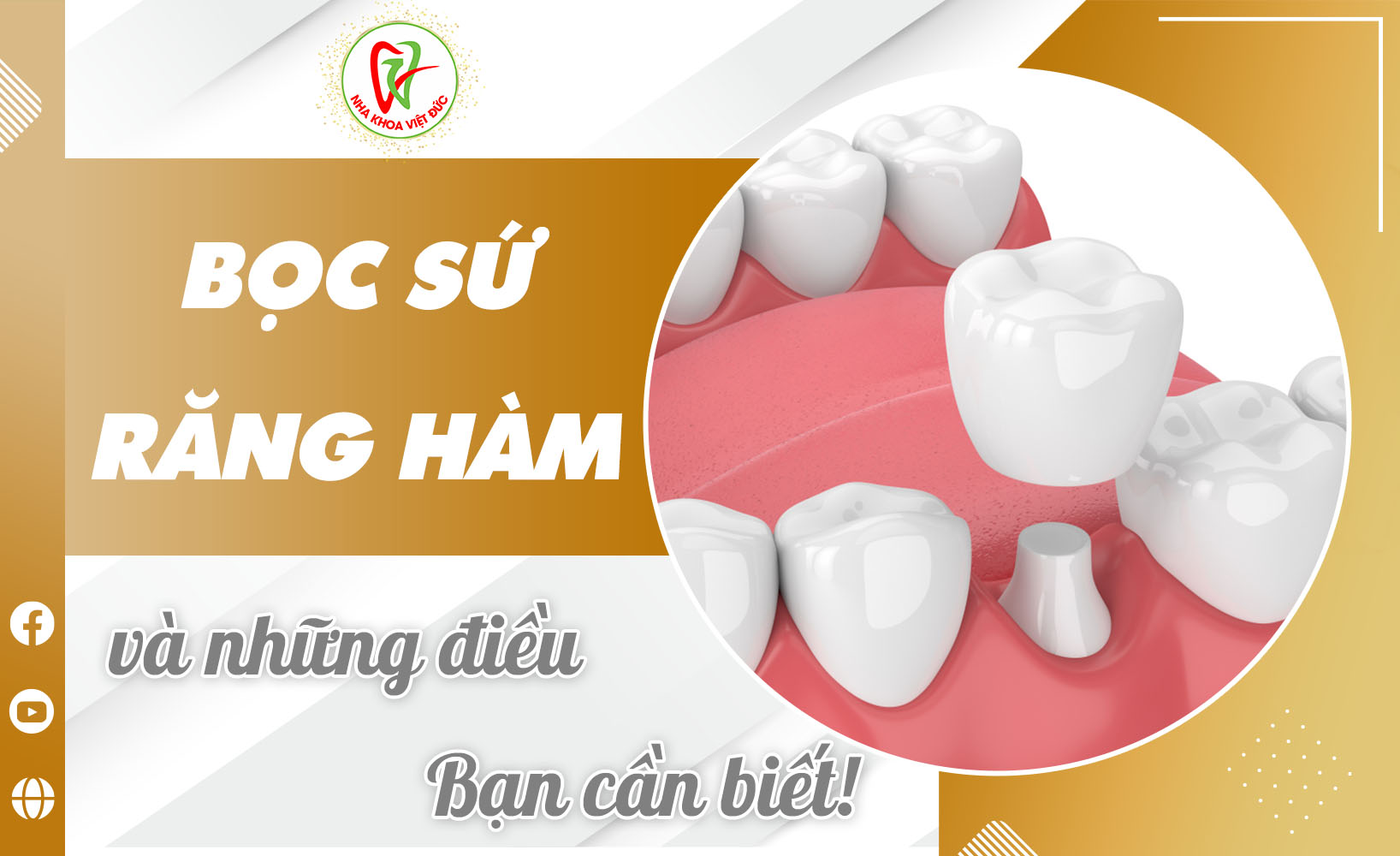 BỌC SỨ RĂNG HÀM VÀ NHỮNG ĐIỀU BẠN CẦN BIẾT