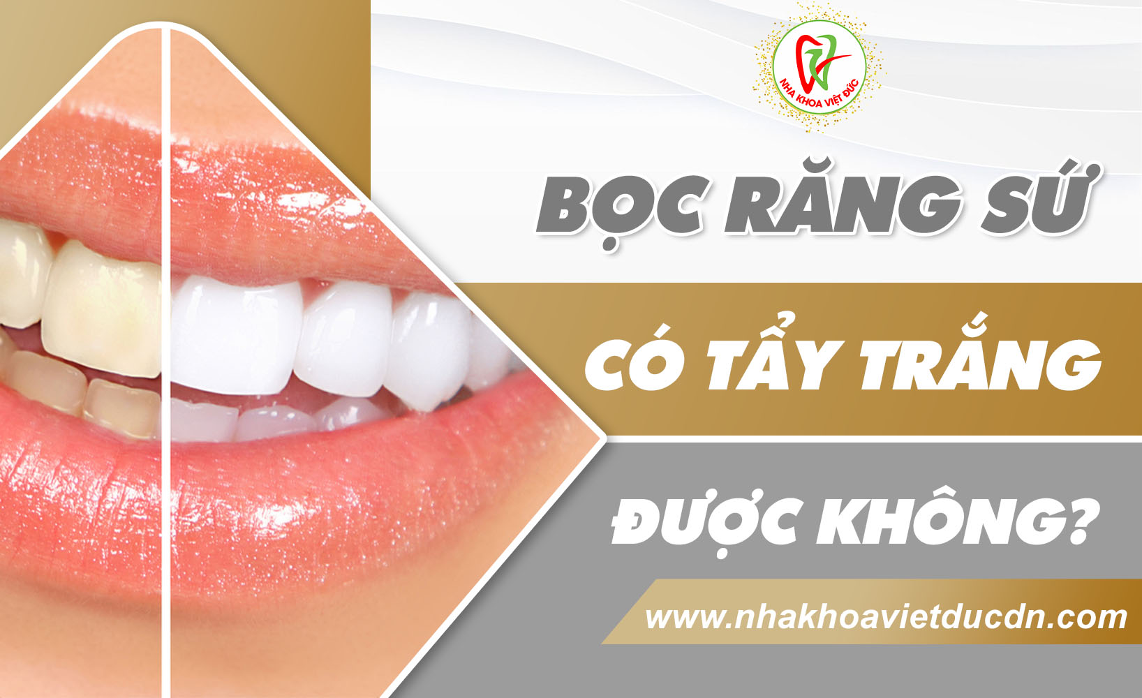 BỌC RĂNG SỨ CÓ TẨY TRẮNG ĐƯỢC KHÔNG?